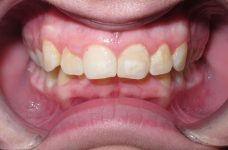 moderate deep bite moderate deep bite