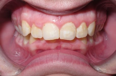 moderate deep bite moderate deep bite