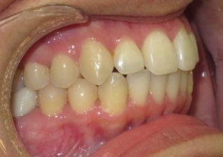 how braces fix a mild posterior crossbite