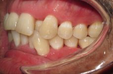 single-tooth anterior crossbite