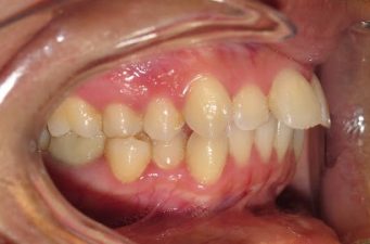 mild posterior crossbite