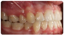 open bite after braces open bite after braces