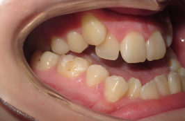 how do braces fix underbites