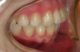 overbite after braces and rubber bands overbite after braces and rubber bands