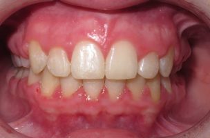 overbite after extractions and braces
