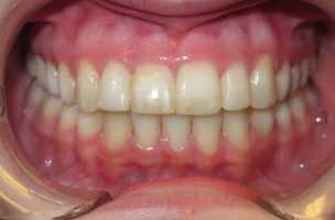 overbite after braces and rubber bands overbite after braces and rubber bands